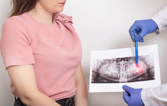 How Will Wisdom Teeth Removal Affect My Daily Routine?